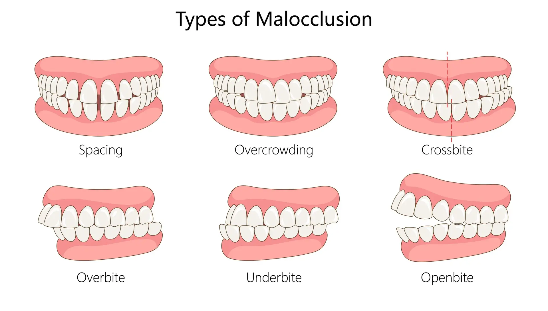 types of malocclusion, including spacing, overcrowding, crossbite, overbite, underbite, and open bite diagram hand drawn schematic vector illustration. Medical science educational illustration